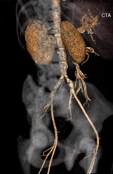 File:Celiac artery severe stenosis and dissection (Radiopaedia 44128-47842 C+ arterial phase 11).jpg