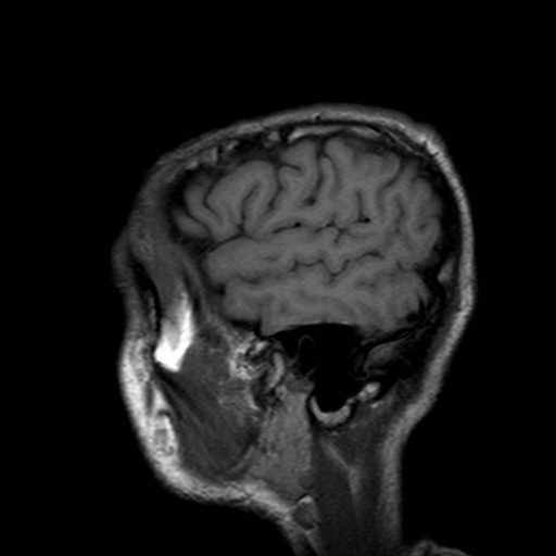 File:Central-variant posterior reversible encephalopathy syndrome (PRES) (Radiopaedia 43880-47358 Sagittal T1 2).jpg
