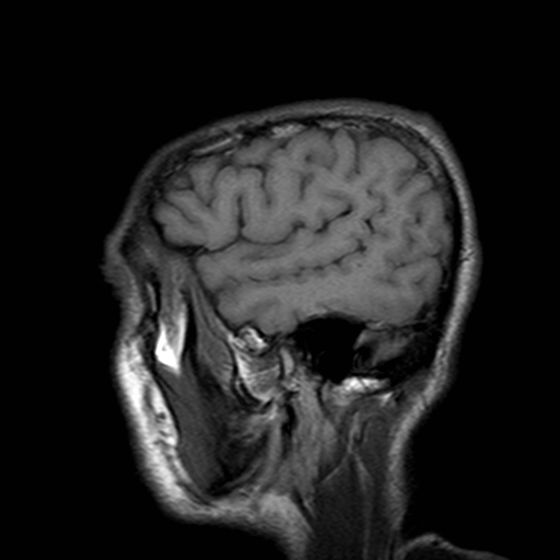 File:Central-variant posterior reversible encephalopathy syndrome (PRES) (Radiopaedia 43880-47358 Sagittal T1 21).jpg