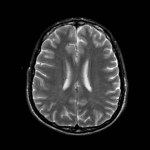 File:Central-variant posterior reversible encephalopathy syndrome (PRES) (Radiopaedia 43880-47359 Axial T2 15).jpg