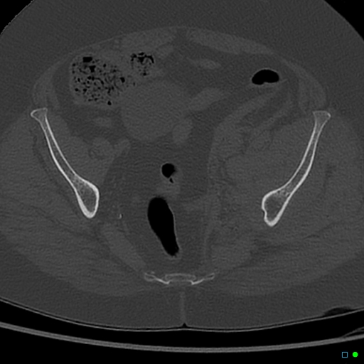 Central fracture-dislocation of the acetabulum (Radiopaedia 36578-38150 Axial bone window 35).jpg