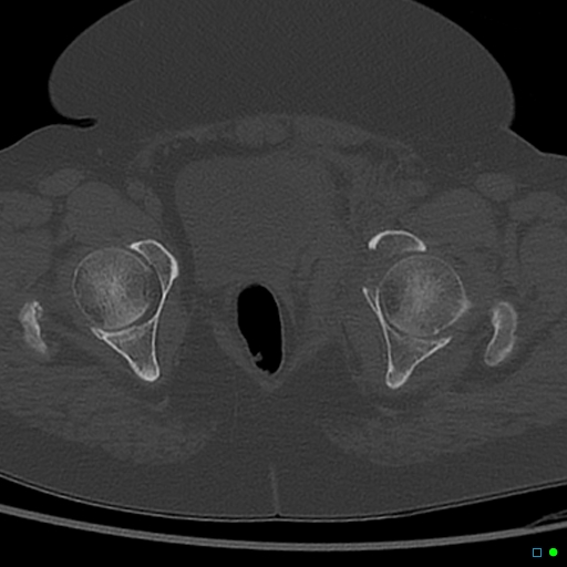 File:Central fracture-dislocation of the acetabulum (Radiopaedia 36578-38150 Axial bone window 63).jpg
