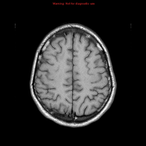 File:Central nervous system vasculitis (Radiopaedia 8410-9235 Axial T1 19).jpg