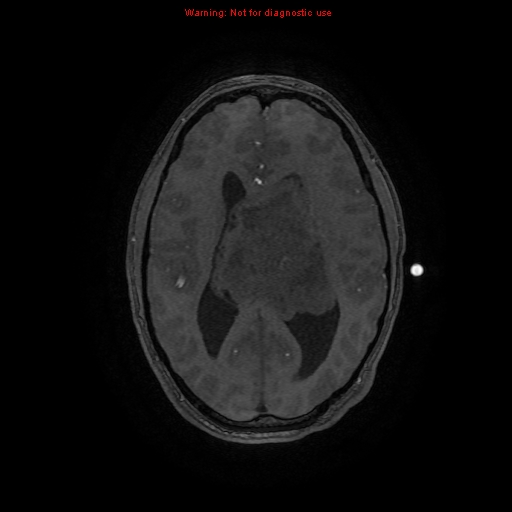 Central neurocytoma (Radiopaedia 13188-13206 Axial MRA 19).jpg