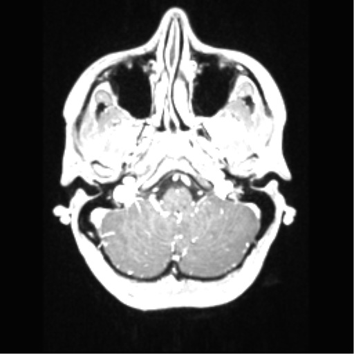 File:Central neurocytoma (Radiopaedia 37664-39557 Axial T1 C+ 16).png