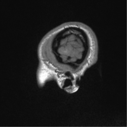 Central neurocytoma (Radiopaedia 37664-39557 Sagittal T1 10).png