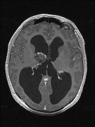 Central neurocytoma (Radiopaedia 56690-63469 Axial T1 C+ 82).jpg