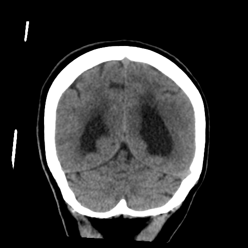 Central neurocytoma (Radiopaedia 65317-74346 Coronal non-contrast 46).png