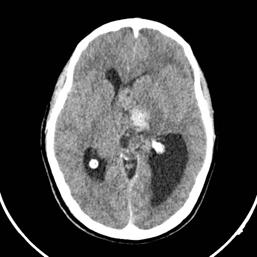 File:Central neurocytoma (Radiopaedia 84497-99871 Axial non-contrast 23).jpg