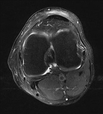 File:Central osteophyte (Radiopaedia 72592-83150 Axial PD fat sat 19).jpg