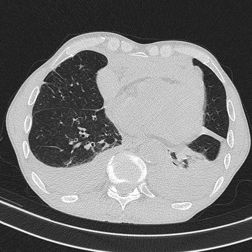 Central venous catheter tip extravasation (Radiopaedia 82828-97113 Axial lung window 60).jpg
