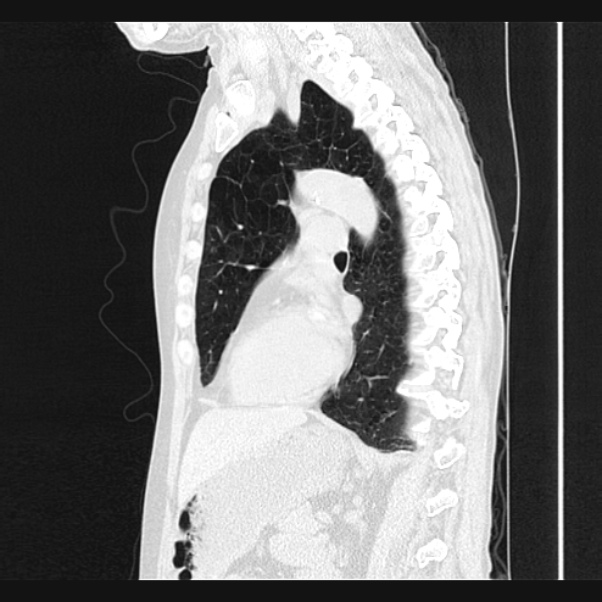 Centrilobular pulmonary emphysema (Radiopaedia 24495-24789 Sagittal lung window 49).jpg