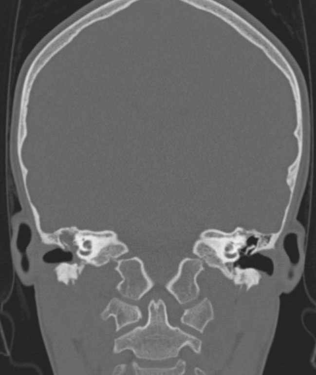 Cerebellar abscess (Radiopaedia 73727-84527 Coronal bone window 62).jpg