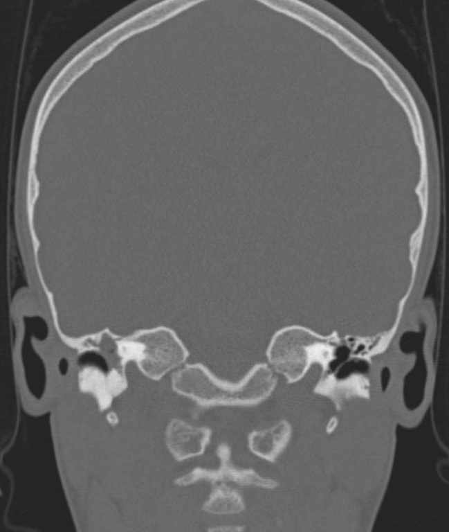 Cerebellar abscess (Radiopaedia 73727-84527 Coronal bone window 70).jpg