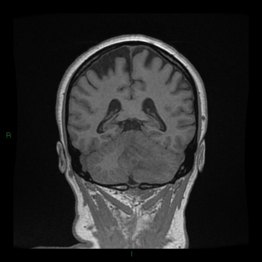 File:Cerebellar abscess (Radiopaedia 78135-90678 Coronal T1 C+ 110).jpg