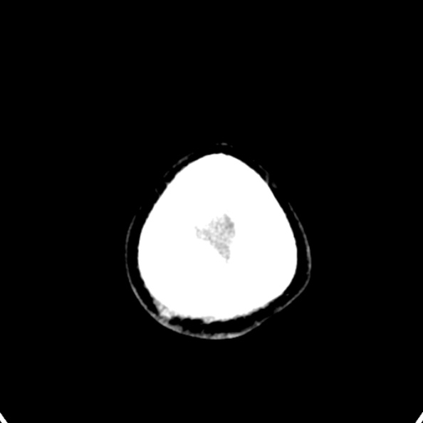 Cerebellar abscess secondary to mastoiditis (Radiopaedia 26284-26412 Axial non-contrast 151).jpg