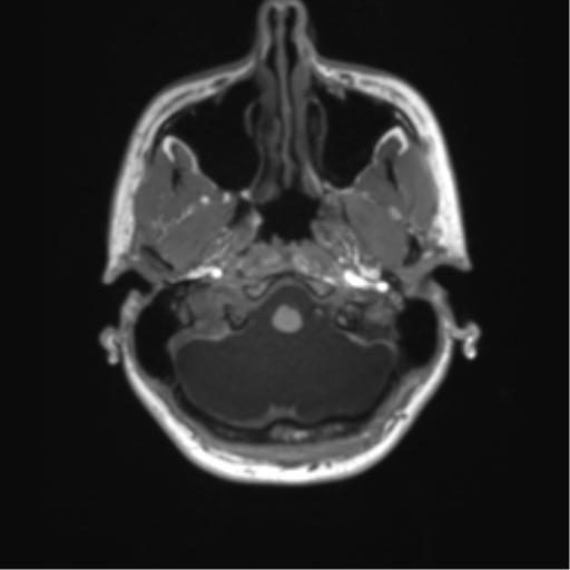 File:Cerebellar agenesis with hypoplastic pons (pontocerebellar hypoplasia) (Radiopaedia 57224-64138 Axial T1 14).png