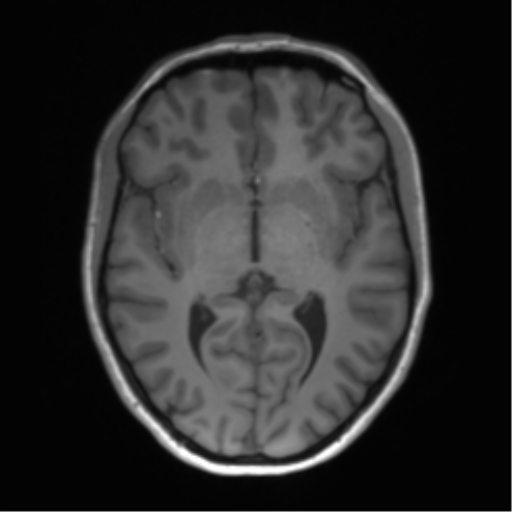 Cerebellar agenesis with hypoplastic pons (pontocerebellar hypoplasia) (Radiopaedia 57224-64138 Axial T1 38).png