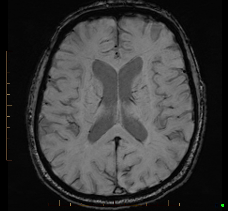 Cerebellar gangliocytoma (Radiopaedia 65377-74422 Axial SWI 34).jpg
