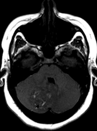 File:Cerebellar hemangioblastoma (Radiopaedia 10779-11234 Axial T1 1).JPG