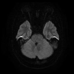 Cerebellar hemangioblastoma (Radiopaedia 29570-30077 Axial DWI 9).jpg