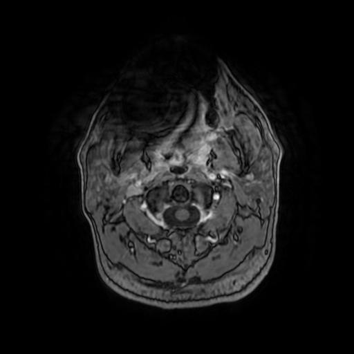 Cerebellar hemangioblastoma (Radiopaedia 88055-104622 Axial T1 C+ 6).jpg