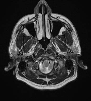 File:Cerebellar hemangioblastomas and pituitary adenoma (Radiopaedia 85490-101176 Axial T2 3).png