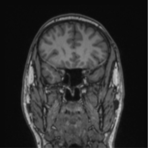 File:Cerebellar hemangioblastomas and pituitary adenoma (Radiopaedia 85490-101176 Coronal T1 65).png
