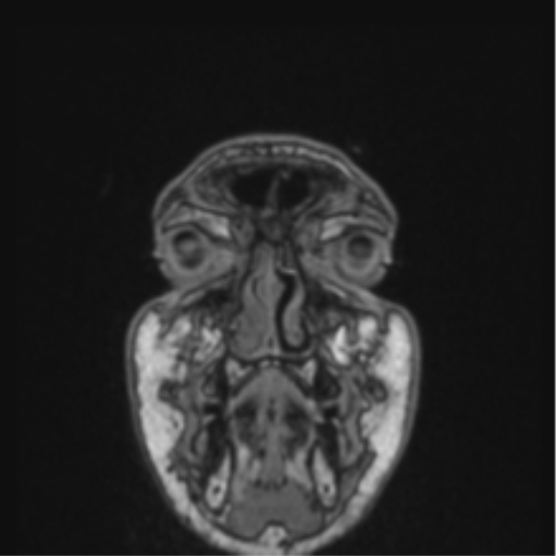 Cerebellar hemangioblastomas and pituitary adenoma (Radiopaedia 85490-101176 Coronal T1 87).png