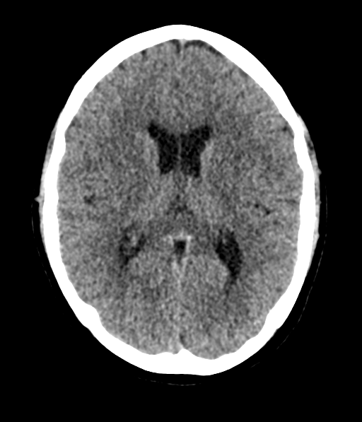 Cerebellar metastases - colorectal adenocarcinoma (Radiopaedia 40947-43652 Axial non-contrast 35).png