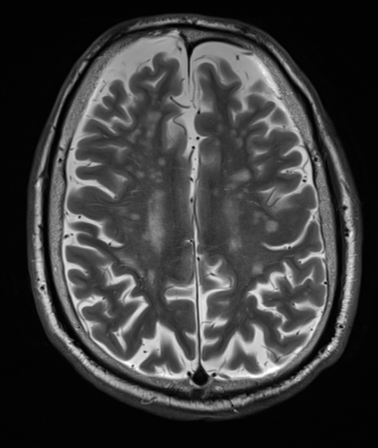 File:Cerebellar metastasis (Radiopaedia 33616-34718 Axial T2 28).png