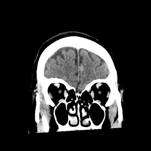 Cerebellar metastasis (cystic appearance) (Radiopaedia 41395-44258 D 15).png