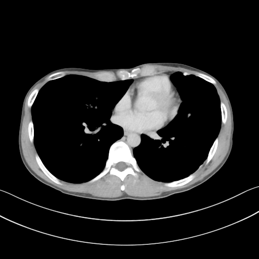 Cerebellar metastasis - adenocarcinoma lung (Radiopaedia 63184-71717 Axial C+ delayed 41).png