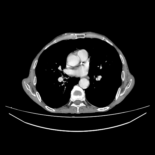 File:Cerebellar metastasis - lung tumor (Radiopaedia 69317-79150 A 19).jpg