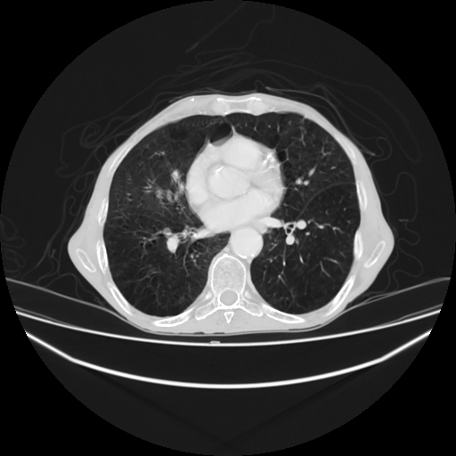 File:Cerebellar metastasis - lung tumor (Radiopaedia 69317-79150 Axial lung window 21).jpg