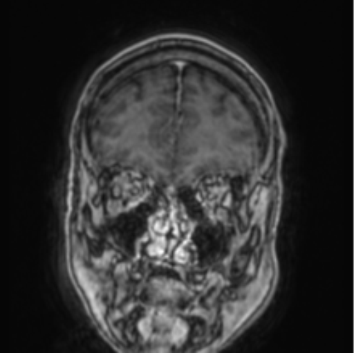 Cerebellar metastasis from lung adenocarcinoma (Radiopaedia 86690-102829 Coronal T1 C+ 79).png