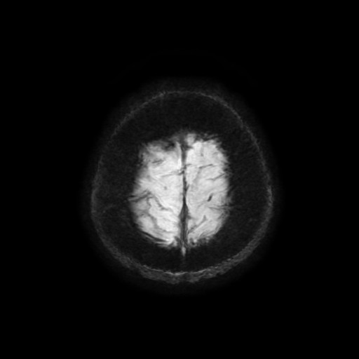 Cerebellar metastasis of pulmonary adenocarcinoma, cavernous venous malformation, and developmental venous anomaly (Radiopaedia 85827-101661 Axial SWI 8).jpg