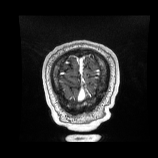 Cerebellar metastasis of pulmonary adenocarcinoma, cavernous venous malformation, and developmental venous anomaly (Radiopaedia 85827-101661 Coronal T1 C+ 15).jpg