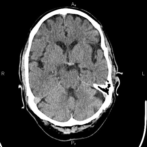File:Cerebellopontine angle arachnoid cyst (Radiopaedia 85149-100704 Axial With contrast 17).jpg