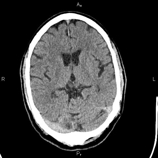 Cerebellopontine angle arachnoid cyst (Radiopaedia 85149-100704 Axial With contrast 24).jpg