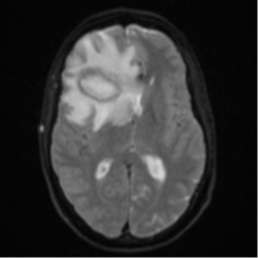 Cerebral abscess (Radiopaedia 60342-68009 Axial DWI 19).png
