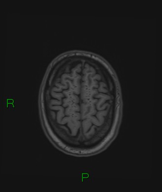 Cerebral abscess and subdural empyema (Radiopaedia 84436-99779 Axial T1 18).jpg