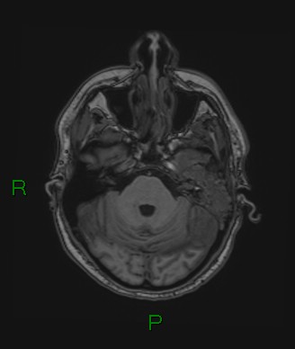 Cerebral abscess and subdural empyema (Radiopaedia 84436-99779 Axial T1 63).jpg