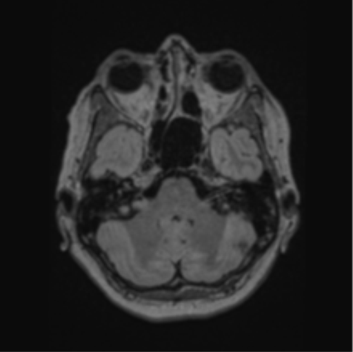 Cerebral abscess from pulmonary arteriovenous malformation (Radiopaedia 86275-102291 J 21).png