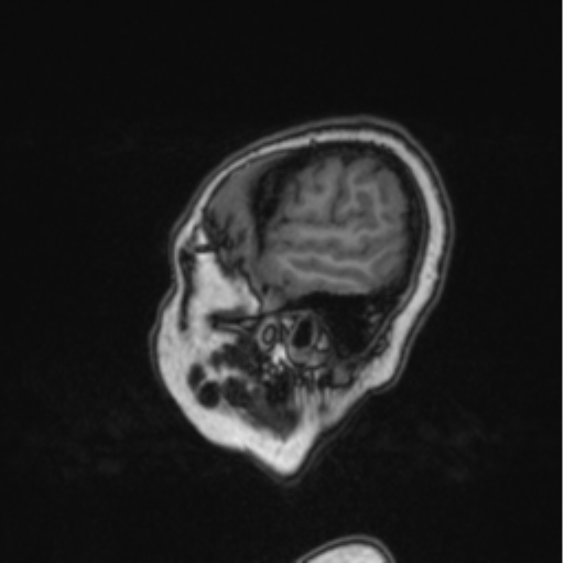 Cerebral abscess from pulmonary arteriovenous malformation (Radiopaedia 86275-102291 Sagittal T1 82).png