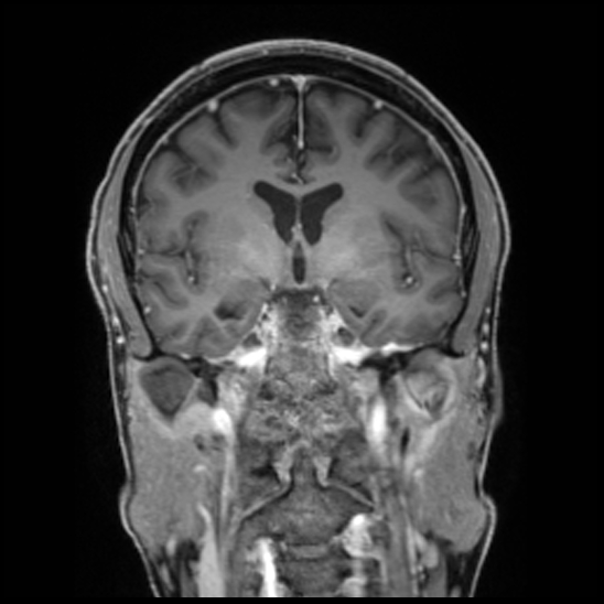 Cerebral abscess with ventriculitis (Radiopaedia 78965-91878 Coronal T1 C+ 30).jpg