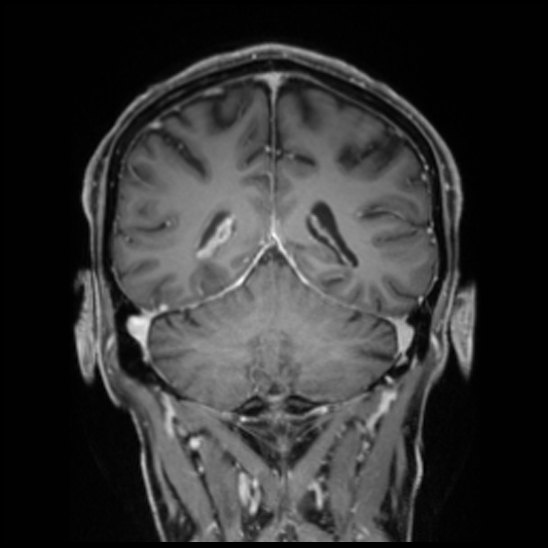 Cerebral abscess with ventriculitis (Radiopaedia 78965-91878 Coronal T1 C+ 44).jpg