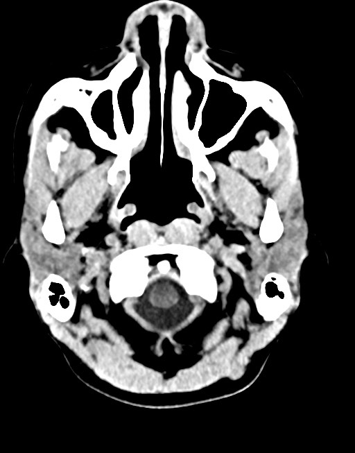 Cerebral abscesses (Radiopaedia 70458-80568 Axial non-contrast 10).jpg