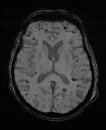Cerebral amyloid angiopathy-related inflammation (Radiopaedia 74836-85849 Axial SWI 40).jpg