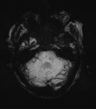 File:Cerebral amyloid angiopathy (Radiopaedia 46082-50433 Axial SWI MIP 17).png